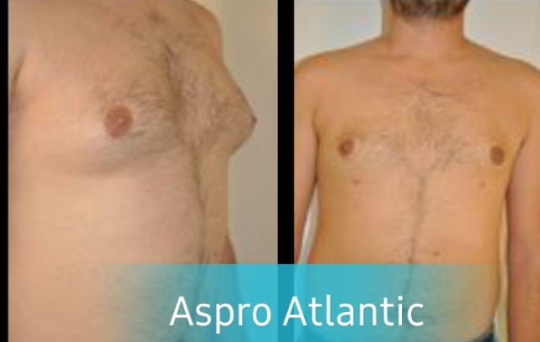  Male breast reduction